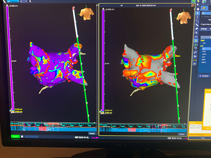 Trójwymiarowa mapa serca pacjenta stworzona w systemie elektroanatomicznym 3D